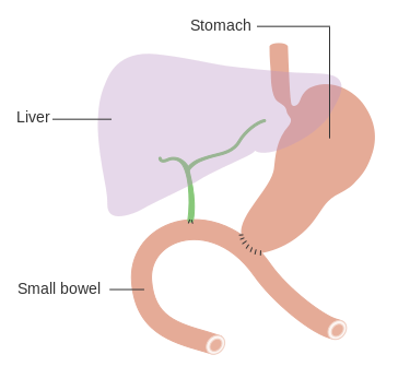 File:Diagram showing how the bowel is joined back together after a total pancreatectomy CRUK 137.svg