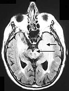 September 7: MRI scan of a patient with Gliomatosis cerebri.