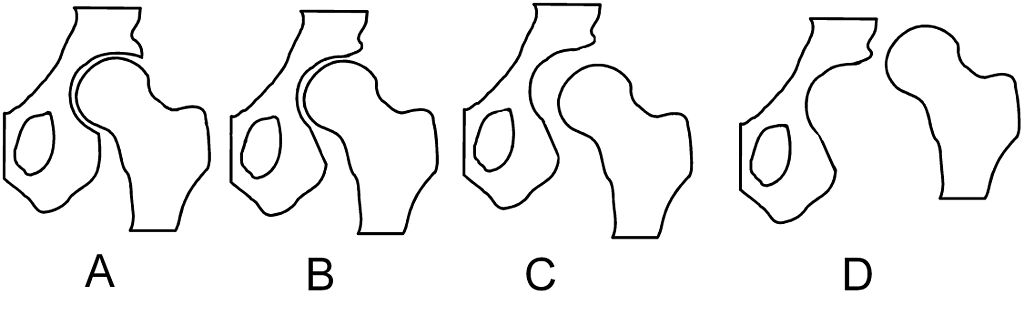 File:Hip dysplasia - - Wikimedia