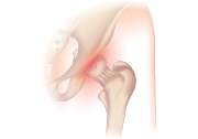 Another common characteristic among BME patients is joint pain, experienced around the affected region. Hip joint pain.svg