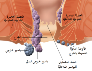 Internal and external hemorrhoids-ar.png