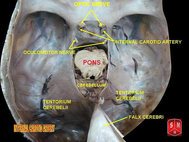 File:Internal carotid artery 4.jpg