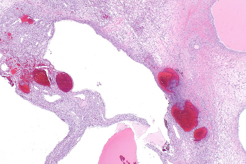 File:Langerhans cell histocytosis within RCC -- extremely low mag.jpg