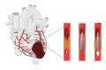 myocardial infarction