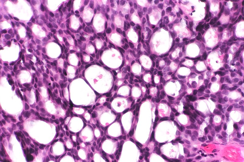 File:Papillary urothelial carcinoma with cribriform morphology, very high mag.jpg