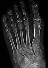 Bipartite medial sesamoid bone under the first metatarsophalangeal joint of the great toe of the left foot of an adult woman.