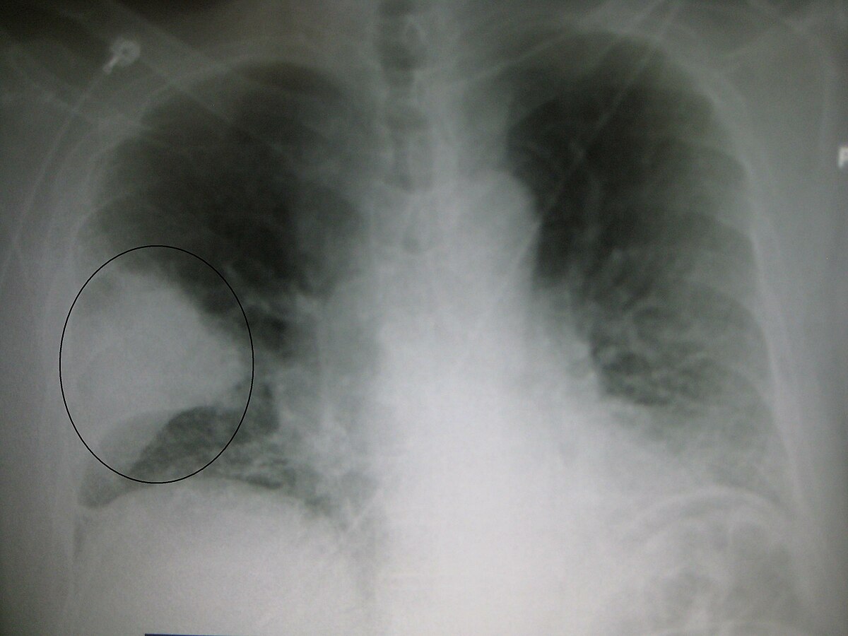 toxoplazma tüdőgyulladás