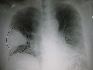 Classification of pneumonia