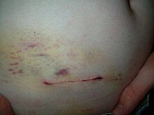 Scar and bruise 2 days after operation SCAR.jpg