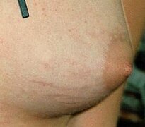 Stretch marks on a female breast.