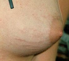 Left: Stretch marks in a female breast, right: Stretch marks (striae gravidarum) can arise during pregnancy or during childbirth as a result of stretching the tissue (slowly as the abdomen grows or quickly when stepping down before and during the expulsion phase during childbirth)