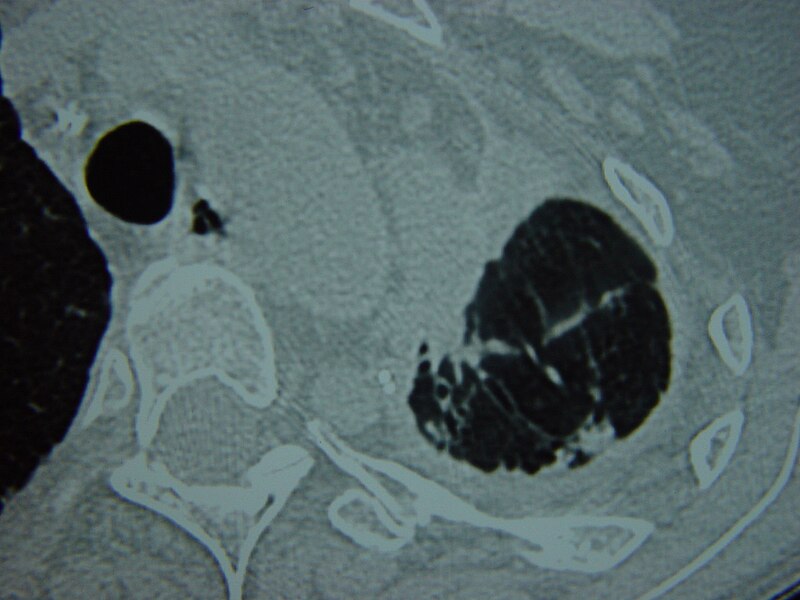 File:Systemic sclerosis case 17 pic 03.jpg