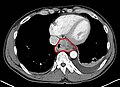 Contrast CT scan showing an esophageal tumor (axial view)