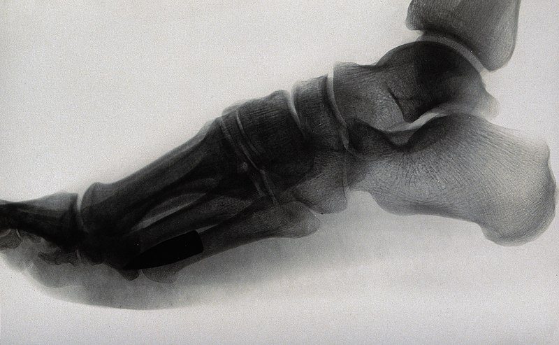 File:X-ray of a foot, showing a bullet Wellcome V0030079.jpg