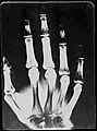 Vorlage: Röntgenaufnahme rechter Hand; S/W Äquidensiten erster Ordnung