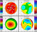 LASIK Voruntersuchung mit einer Pentacam - Hornhauttopographie 4er Karte:Krümmungskarte, Höhendaten der Vorderfläche und der Rückfläche, Dickenkarte der Hornhaut