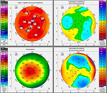 Preliminary investigation of the corneal topography. The test maps a patient's cornea for raised areas and surface inconsistencies. Augenlasern-Voruntersuchung-der-Hornhaut-Topographie-vor-LASIK-OP.jpg