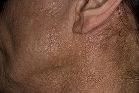 Характерные для синдрома Бёрта — Хога — Дьюба фиброфолликуломы на коже лица