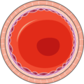 Atheroma 16