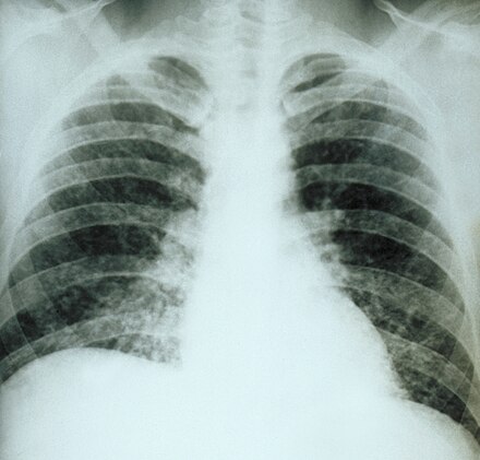 Chest X-ray of a patient with acute pulmonary histoplasmosis