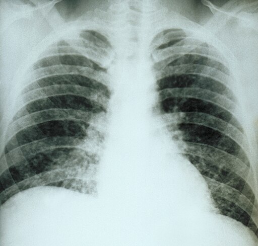 Chest X-ray acute pulmonary histoplasmosis PHIL 3954