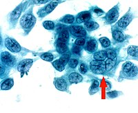 Impression cytology smear stained by Papanicolaou stain shows the presence of a multinucleated giant cell Cytology corneal herpes multinucleated cell.jpeg
