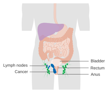 File:Diagram showing stage 3 anal cancer CRUK 217.svg