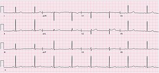 ECG of a 64-year-old female with sinus bradycardia