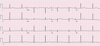 Electrocardiogram (ECG) of a 64-year-old female with sinus bradycardia. Heart rate 49 bpm. ECG Sinus Bradycardia 49 bpm.jpg