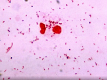 gram negative diplococci in sputum