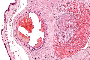 Fibrina: Papel en enfermidades, Fisioloxía, Notas