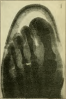 Foot care and shoe fitting-Fig47 Foot in a 1920 US marine corps last Sufficient length but insufficient breadth, hallux valgus.png