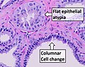 Thumbnail for File:Histopathology of flat epithelial atypia and columnar cell change.jpg