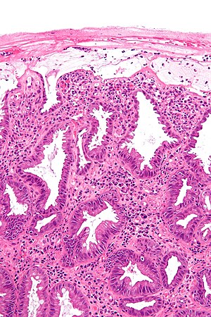 Ischemic colitis - high mag.jpg