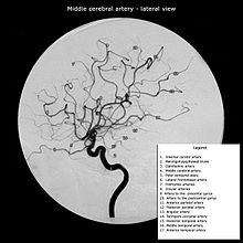 Middle cerebral artery and its branches (patient has a hypoplastic A1 segment and an absent PCOM, resulting in a purely MCA angio from internal carotid artery injection) MCA angio lateral.jpg