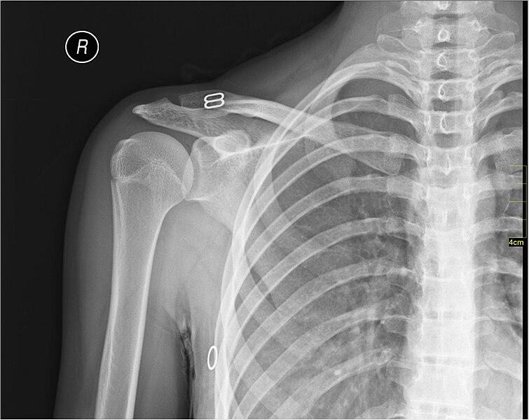 File:Medical X-Ray imaging PUW06 nevit.jpg