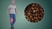 Reduced bone mineral density in Osteoporosis (R), increasing the likelihood of fractures Osteoporosis in Bones.jpg
