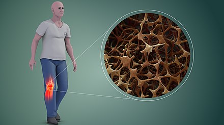 Reduced bone mineral density in Osteoporosis (R), increasing the likelihood of fractures