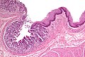 Pancreatic acinar metaplasia.