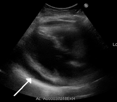 Ultrasounds showing a pericardial effusion in someone with pericarditis
