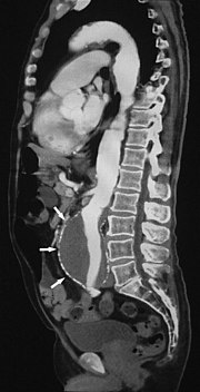 Thumbnail for Computed tomography angiography