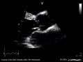 File:Severe aortic regurgitation E00180 (CardioNetworks ECHOpedia).webm