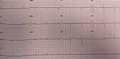 EKG en un paciente con síndrome de Wellens cuando tiene dolor en el pecho