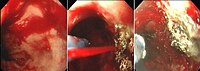 APC of bleeding oesophageal ulcer APC oesophagus.jpg