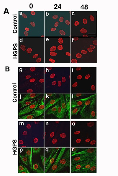 File:Confocal analysis of dermal fibroblasts after heat shock stress (progeria).jpg