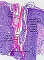 Illustrated image showing Demodex folliculorum