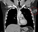 Dermatofibrosarcoma protuberans CT cor.jpg