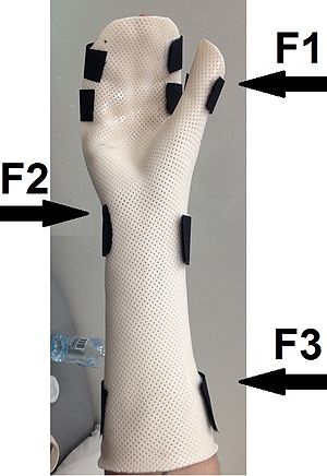 Three point force system to produce ulnar deviation of the wrist.