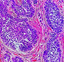 High-magnification micrograph of basal-cell carcinoma High-magnification micrograph of basal-cell carcinoma.jpg