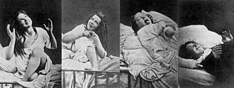 Quatre photographies en noir et blanc d'une jeune femme, dans un lit d'hôpital à ridelles, prise de crises d'hystérie entre 1876 et 1880. Sur trois d'entre elles, la jeune femme est souriante, les yeux levés au ciel, les gestes expressifs ; sur la quatrième, elle est couchée les yeux fermés, tirant la langue, les bras fortement croisés sur la poitrine.